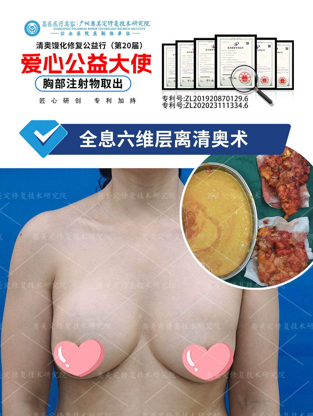 奥美定隆胸后会怎么样