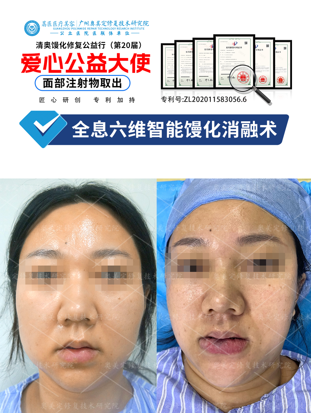 苹果肌生长因子取出修复