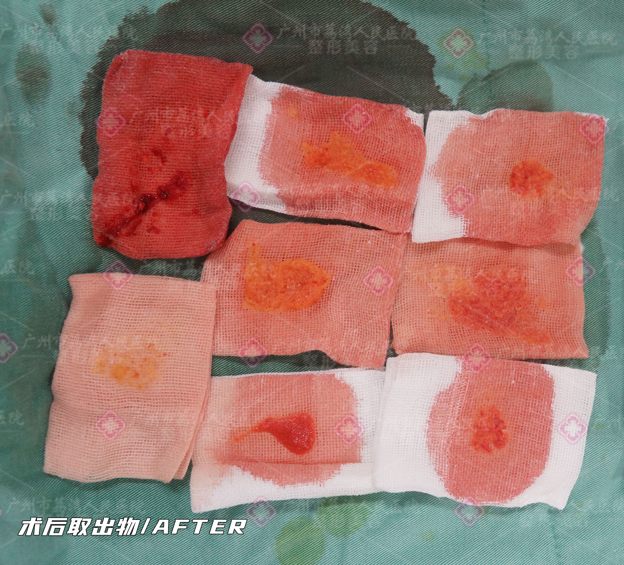 水分子丰体针是对人体健康有害吗