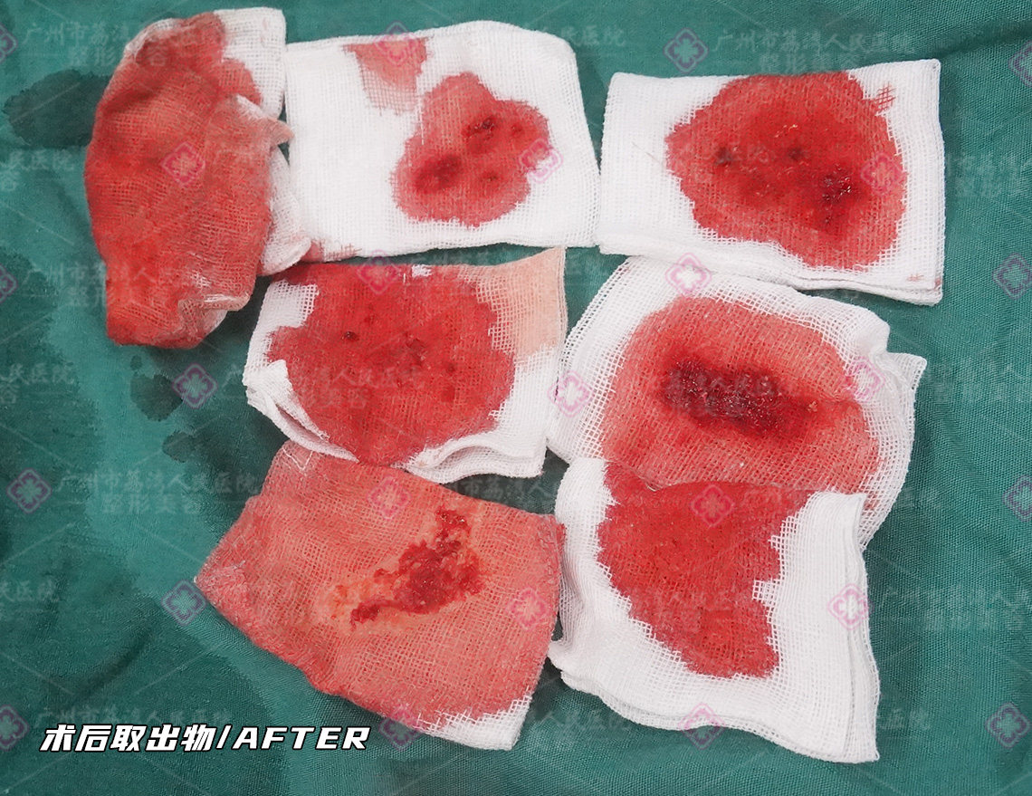 水分子丰体针注射物应该取出吗